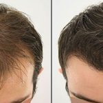 Istanbul Hair Transplant Doctors With Great Reputations