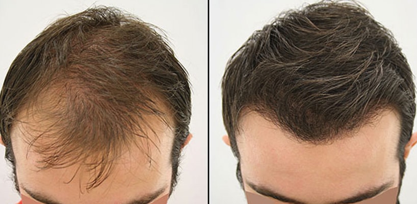 Istanbul Hair Transplant Doctors With Great Reputations