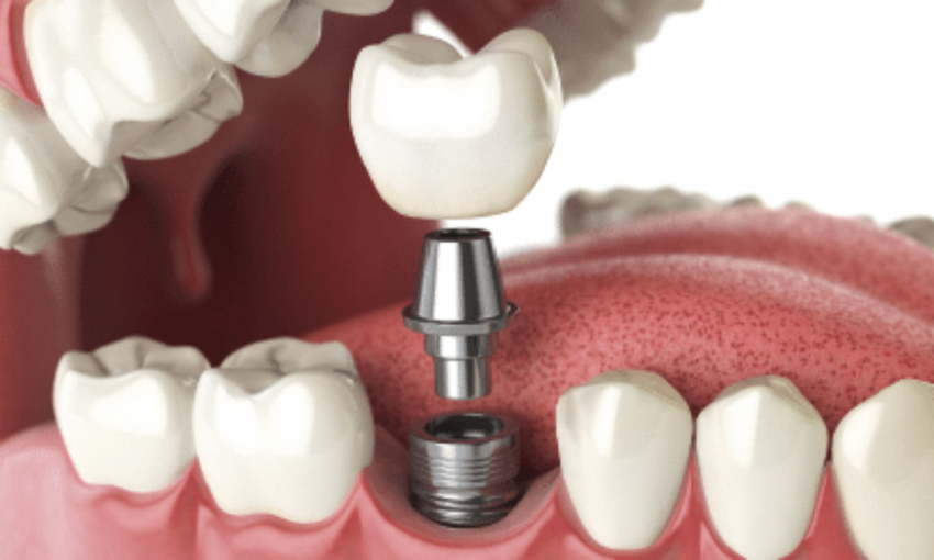 The very best Countries to Experience Dental Implants Abroad